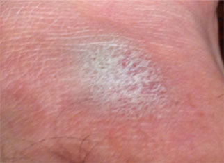 Close up image of skin with eczema flare up.