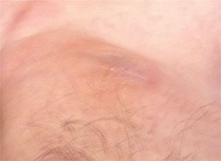 Close up image of skin after treatment for eczema.