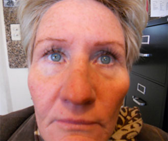 Image of woman with hyperpigmentation.