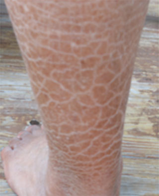 Image of a leg with servere scaling due to very dry skin.