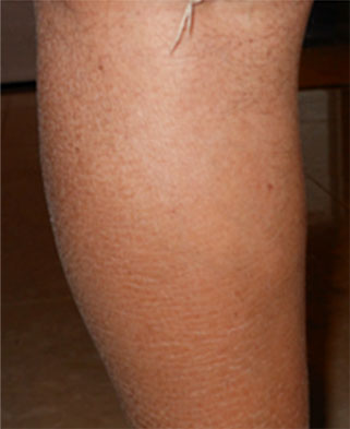 Image of a leg after treatment for servere scaling due to very dry skin.