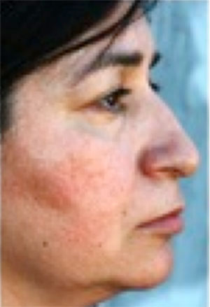 Image of woman suffering from rosacea.