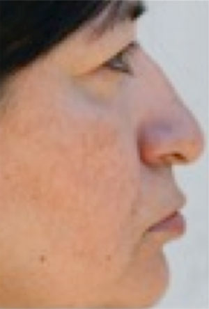 Image of a woman after treatment who suffers from rosacea.