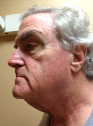 Image of a man before treatment for conditions typically seen with diabetes.