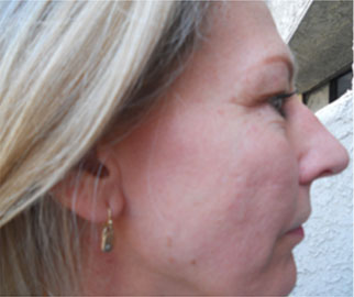 Before image of woman with dry skin, age spots, fine lines and wrinkles.