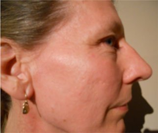 Image of a woman after treatment for dry skin, age spots, fine lines and wrinkles.