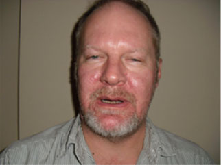 Image of man with acne vulgaris before treatment.