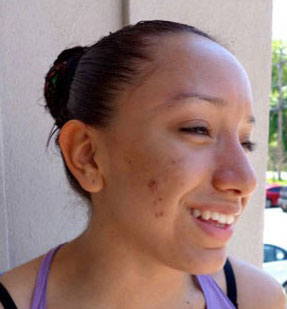 Before image of woman with combination skin.