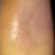 Before and after results for eczema.