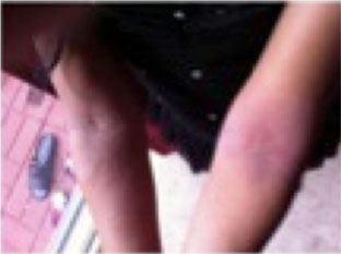 Image of girls arms before treatment for eczema.