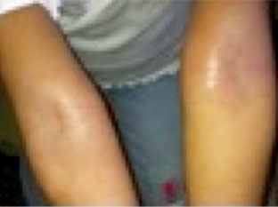 Image of girls arms after treatment for eczema.