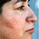 Before and after results of Rosacea.